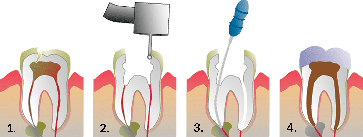 One-Visit Root Canals in South Fort Worth